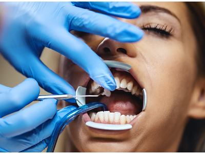 拔牙后的注意事項和飲食禁忌