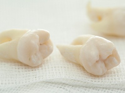 智齒疼了，這牙非拔不可嗎？