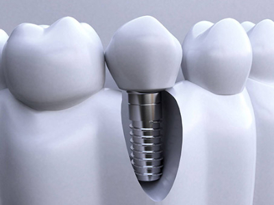 承德種植牙價格表，2024種植牙多少錢一顆呢?