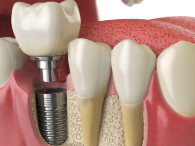 選擇種植牙后要做哪些日常維護(hù)？