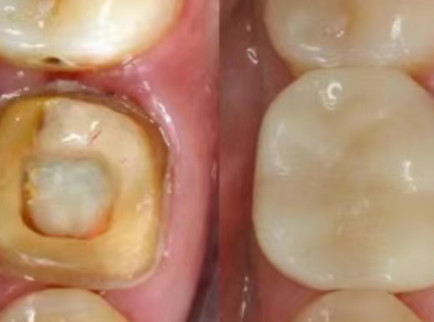 根管治療（抽神經(jīng)）后，為什么一定要做牙冠？