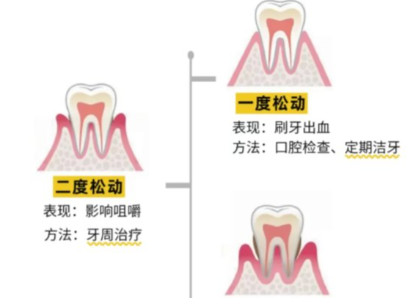 老年人牙齒松動(dòng)了要怎么辦？