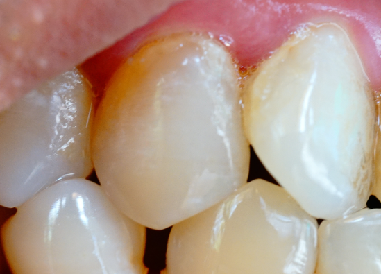 牙齒表面的牙釉質(zhì)掉了還可以修復嗎？