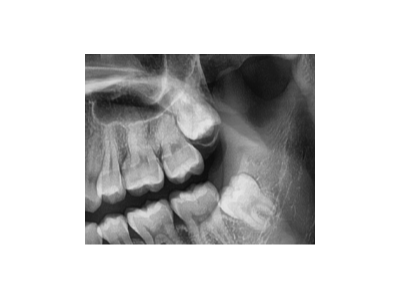 既然「智齒」不宜久留，為什么不能一次性拔掉？