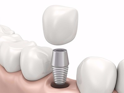 在承德哪家口腔醫(yī)院口腔種植齒好一點，惟德口腔醫(yī)院值得您的選擇