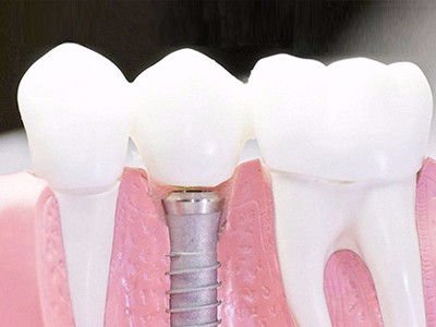 在承德口腔種植齒需要多少錢？惟德口腔一一為您道來