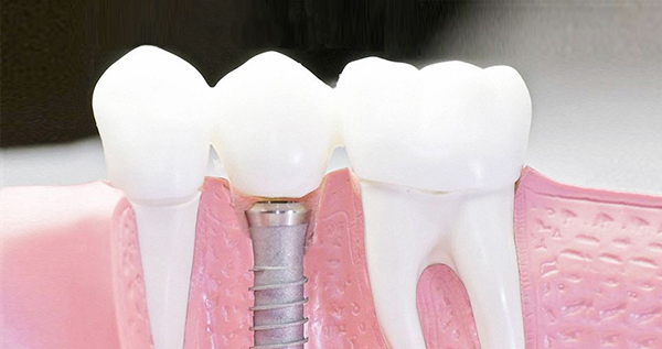 在承德口腔種植牙齒需要多少錢？惟德口腔一一為您道來