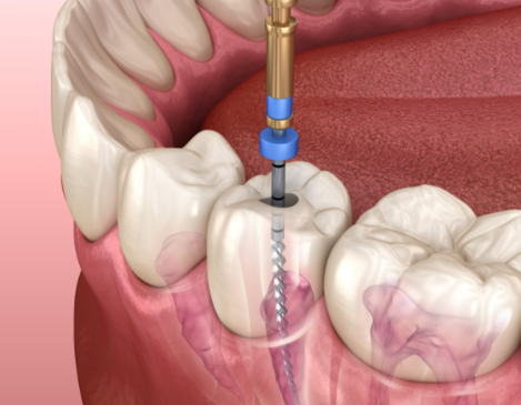根管治療后的注意事項有哪些？